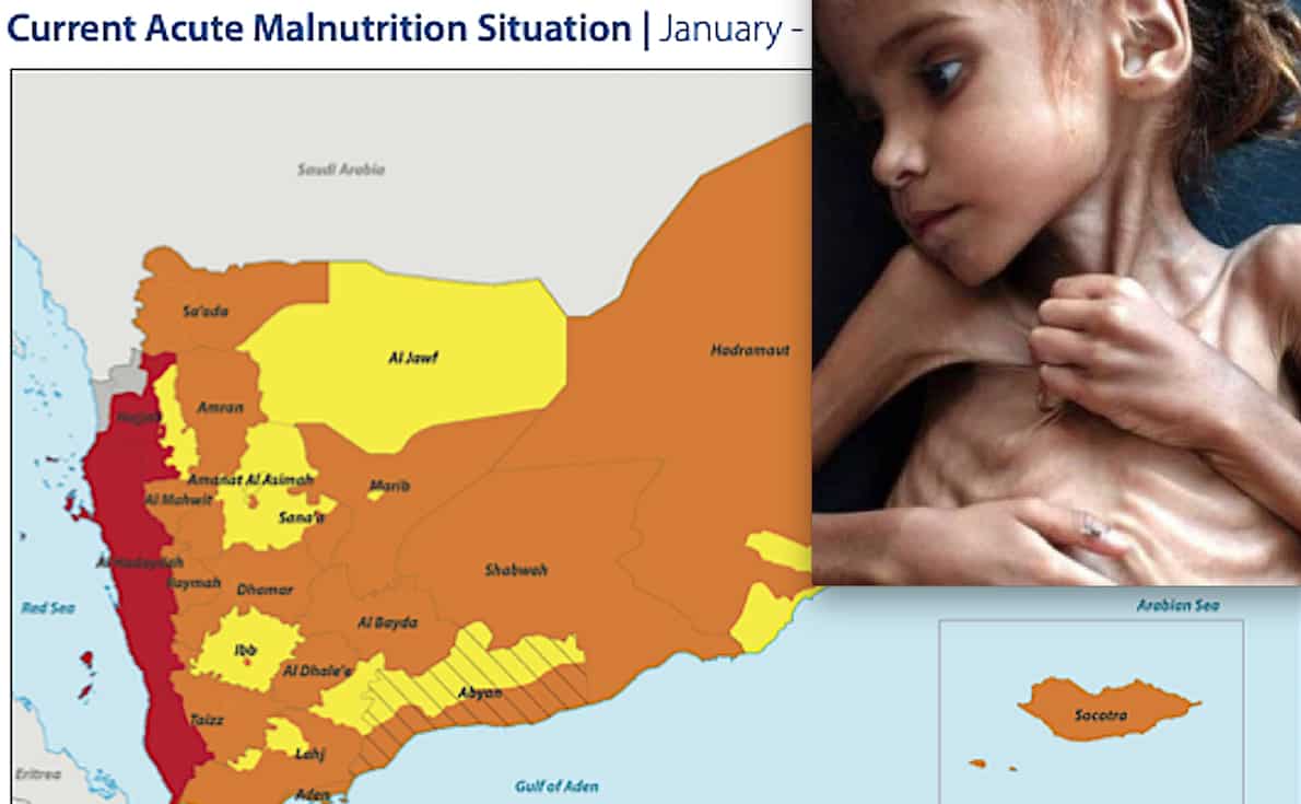 Worse than Ukraine! Due to Saudi War in Yemen 161,000 Face “Catastrophic” Hunger. 400,000 Toddlers at “Risk of Death”
