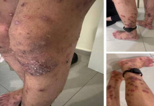 PPS: Most Released Detainees Suffer Health Complications